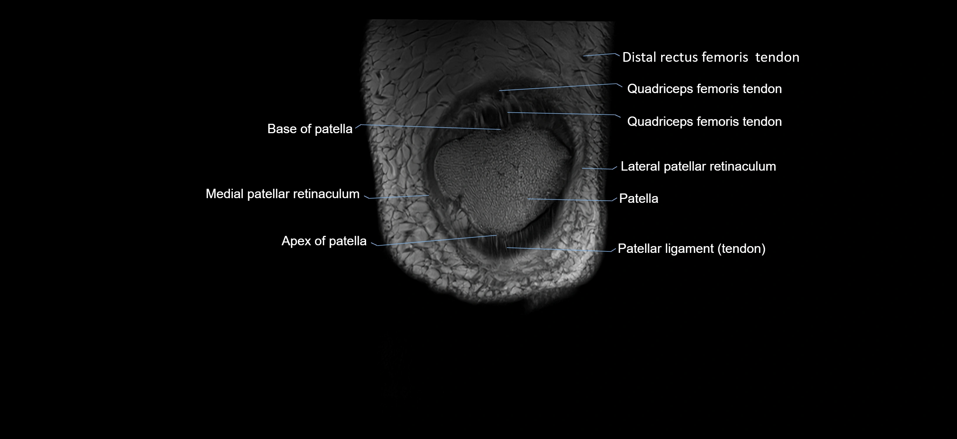 MRI knee coronal cross sectional anatomy labelled 3T radiology  image-04001-00004.webp